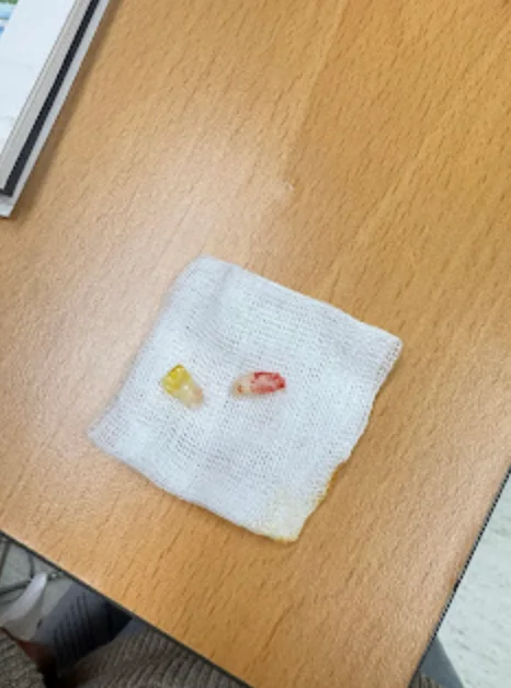 수술 당일 뽑은 과잉치와 흔들리는 유치